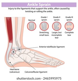 Detailed diagram of ankle sprain types