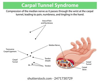 Detailed diagram of carpal tunnel syndrome symptoms