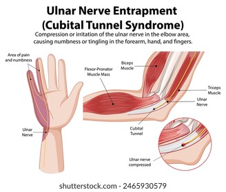 Detailed diagram of cubital tunnel syndrome