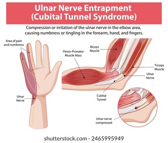 Detailed diagram of cubital tunnel syndrome