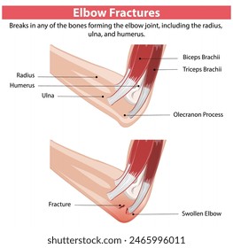 Diagrama detallado de las fracturas del codo