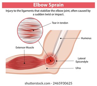 Detailed diagram of an elbow sprain injury