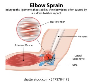 Detailed diagram of an elbow sprain injury