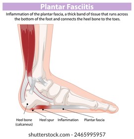 Detailed diagram of foot inflammation