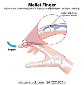 Detailed diagram of mallet finger injury