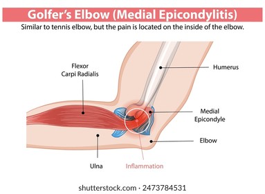 Detailed diagram of medial epicondylitis