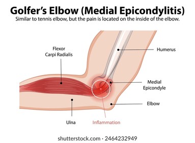 Detailed diagram of medial epicondylitis in the elbow