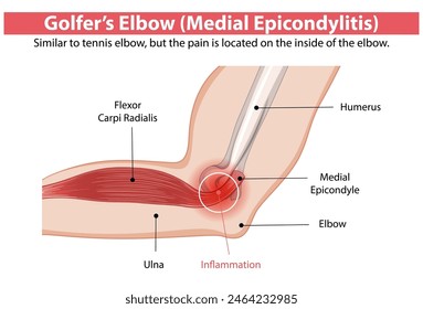 Detailed diagram of medial epicondylitis in the elbow