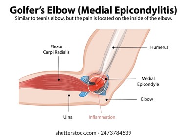 Diagrama detallado de la epicondilitis medial en el codo