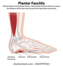 Detailed diagram of plantar fasciitis in the foot