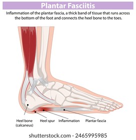 Detailed diagram of plantar fasciitis in the foot
