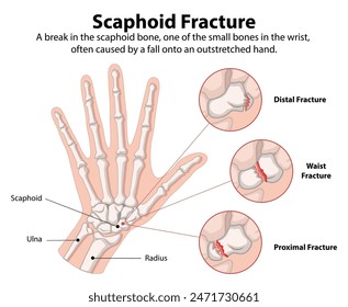 Detailed diagram of scaphoid bone fractures