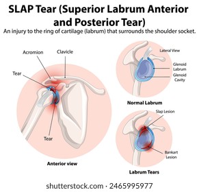 Diagrama detallado del desgarro de SLAP en la articulación del hombro