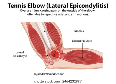 Detailed diagram of tennis elbow condition