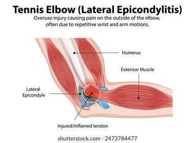 Detailed diagram of tennis elbow condition