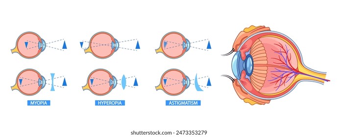 Detaillierte Augenanatomie-Infografik zur Erklärung von Myopie, Hyperopie und Astigmatismus. visuelle Darstellung der Augenstruktur