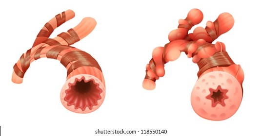 1,904 Bronchospasm Images, Stock Photos & Vectors | Shutterstock