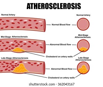 Detailed illustration of atherosclerosis stages (for basic medical education, for clinics & Schools)