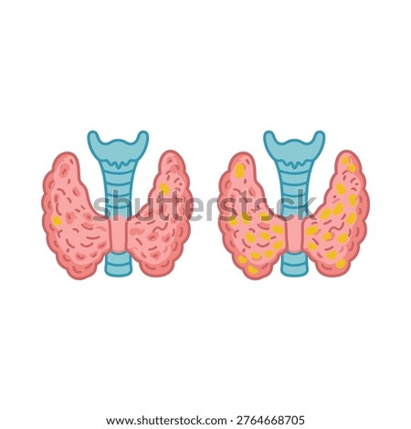 Detailed illustration comparing a normal thyroid gland to one exhibiting notable enlargement and nodules.