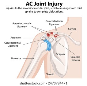 Ilustración detallada de la lesión articular del hombro