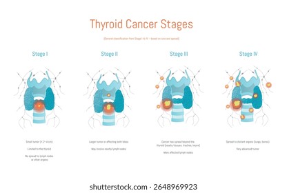 Ilustração detalhada mostrando os estágios da progressão do câncer de tireoide, desde pequenos tumores até a disseminação avançada. Vital para a educação médica e compreensão da saúde e anatomia da tireoide