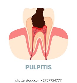 Detailed isolated diagram showing pulpitis dental problem with inflamed tooth nerve and cavity vector illustration
