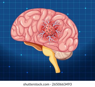 Ilustração vetorial detalhada de um cérebro destacando uma célula cancerosa. Apresenta cores vibrantes e precisão científica em um plano de fundo de grade