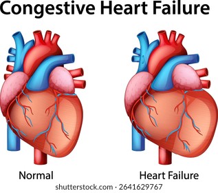 Detailed vector illustration comparing normal heart anatomy with heart failure. Vivid colors and clear labels enhance understanding