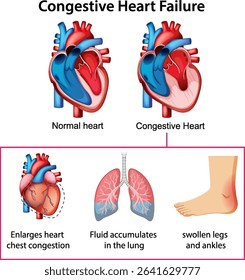 Detailed vector illustration comparing normal and congestive heart conditions, highlighting symptoms like fluid accumulation and swelling