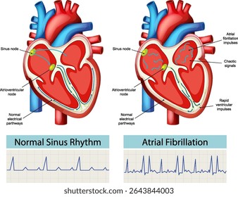 Ilustração vetorial detalhada comparando o ritmo sinusal normal e a fibrilação atrial com a anatomia do coração marcada e traços de ECG