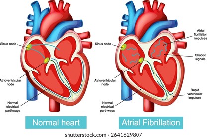 Detailed vector illustration contrasting normal heart function with atrial fibrillation, highlighting electrical pathways and nodes