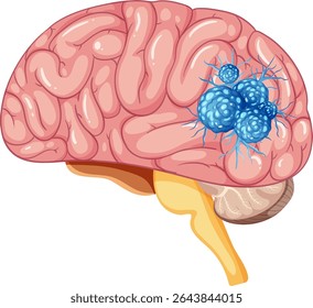 Detailed vector illustration of a human brain highlighting a tumor. Realistic colors and clear composition for educational use