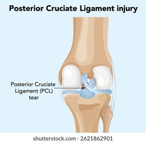 Detailed vector illustration of a knee joint highlighting a posterior cruciate ligament tear with labeled anatomy