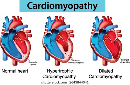 Ilustração vetorial detalhada de cardiomiopatia normal, hipertrófica e dilatada. Cores vivas e rótulos claros aumentam o valor educacional
