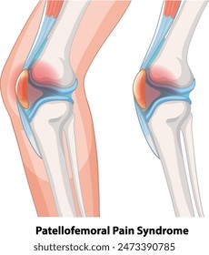 Detailed vector of knee pain anatomy