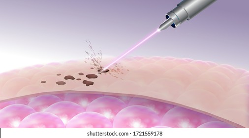 Details for laser freckles and dark spot removal On the upper skin Does not affect the cells under the skin. Realistic file.