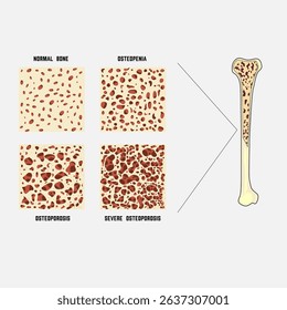 Deterioration of human bone, osteoporosis, osteopenia, severe osteoporosis.