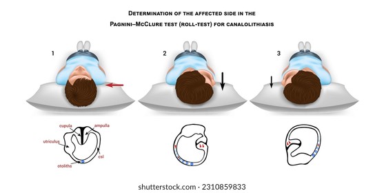 Determination of the affected side in the Pagnini-McClure test (roll-test) for canalolithiasis. Methodological guide. Illustration in a realistic style. Vector.