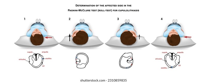 Determination of the affected side in the Pagnini-McClure test (roll-test) for cupulolithiasis. Methodological guide. Illustration in a realistic style. Vector.