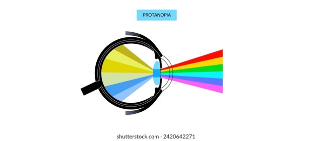 Deuteranopia vision eye abnormality, color blindness infographic. Human vision deficiency concept. Difference between colors, brightness and intensity of shades flat vector illustration