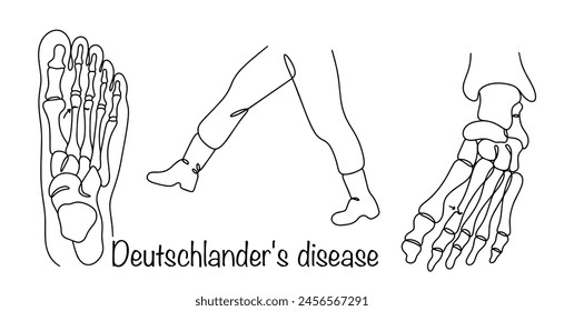 Deutschlander's disease. A bone fracture caused by fracture due to repetitive stress. A common illness among people who march. Simple hand drawn vector illustration.