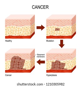 Developing Cancer. From Normal Cells To Mutation, Hyperplasia, And Malignant Tumor. Neoplasia. Vector Diagram For Educational, Medical, Biological And Science Use