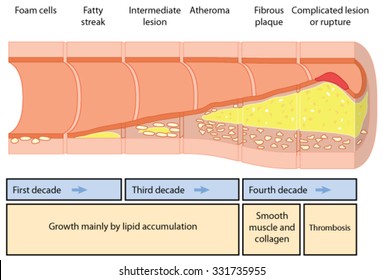 Development Of An Atheromatous Plaque In An Artery Over Four Decades.