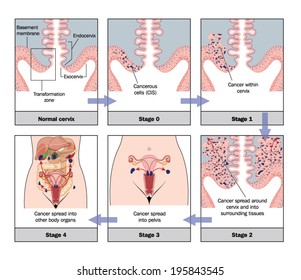 Desarrollo de cáncer de cuello de útero — etiquetado