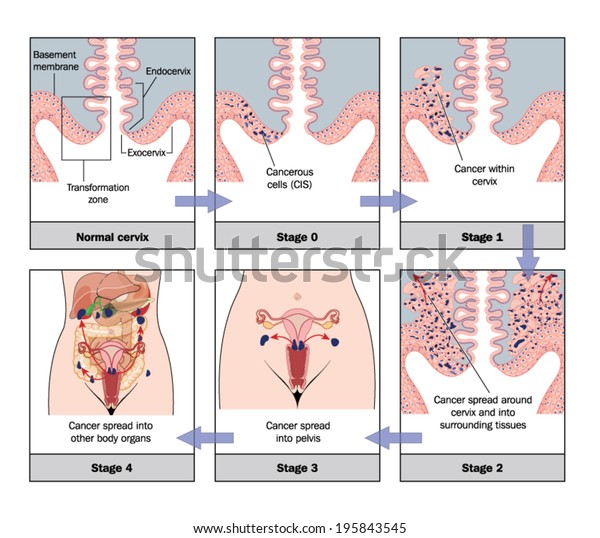 Development Cervical Cancer Labelled Stock Vector Royalty Free 195843545