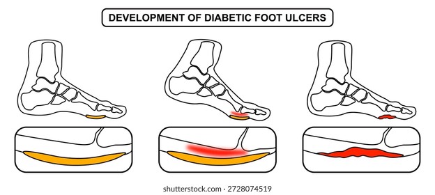 Desarrollo de úlceras del pie diabético. Formación de callos superficiales, presión en el pie, inflamación y sangrado, expansión de la úlcera, úlcera profunda. Vector de dibujo de líneas para médico, clínica y cartel