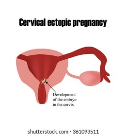 Development of the embryo in the cervix. Ectopic pregnancy. Infographics. Vector illustration on isolated background.
