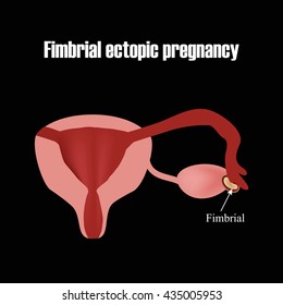 Development of the embryo in the fimbrial department. Ectopic pregnancy. Infographics. Vector illustration.