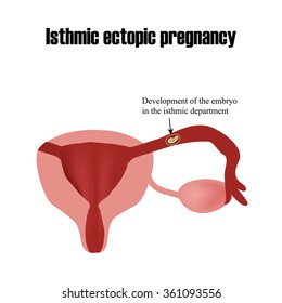 Development of the embryo in the isthmic department. Ectopic pregnancy. Infographics. Vector illustration on isolated background.