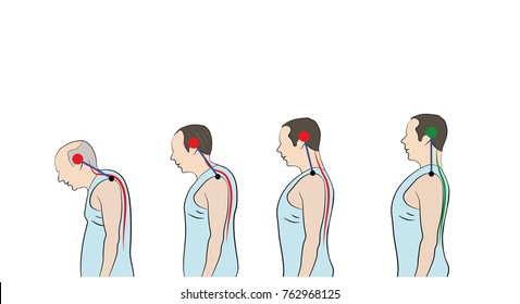 Development of a stooped stance with age, showing increasing curvature of the spine